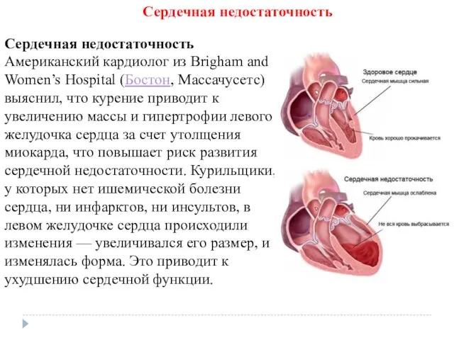 Сердечная недостаточность Американский кардиолог из Brigham and Women’s Hospital (Бостон, Массачусетс)