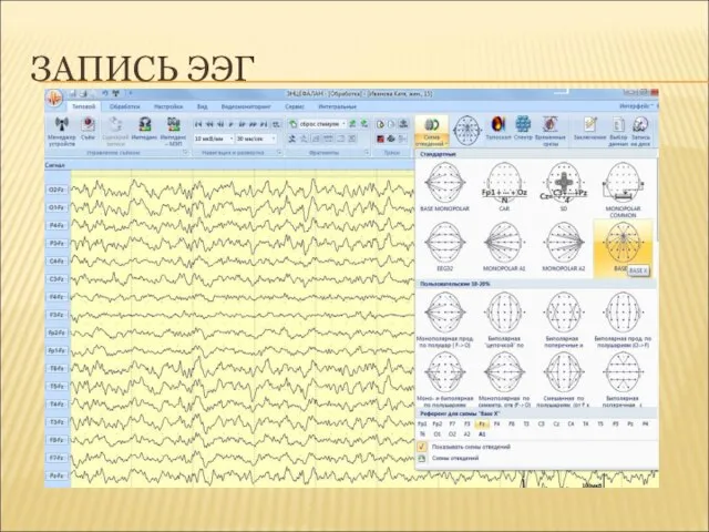 ЗАПИСЬ ЭЭГ