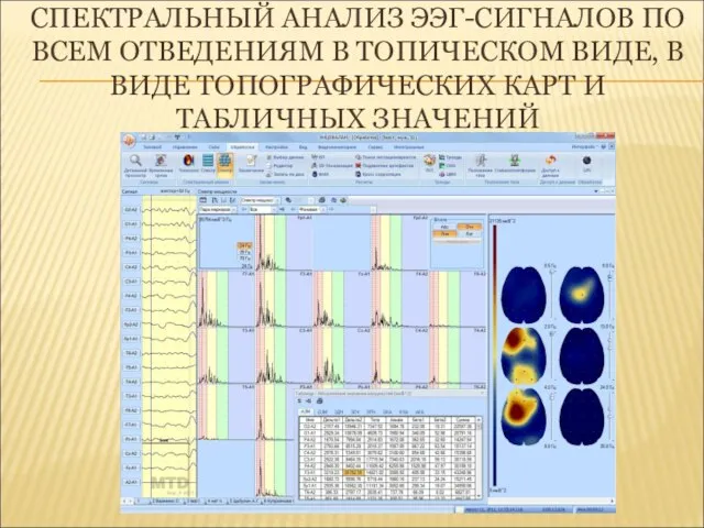 СПЕКТРАЛЬНЫЙ АНАЛИЗ ЭЭГ-СИГНАЛОВ ПО ВСЕМ ОТВЕДЕНИЯМ В ТОПИЧЕСКОМ ВИДЕ, В ВИДЕ ТОПОГРАФИЧЕСКИХ КАРТ И ТАБЛИЧНЫХ ЗНАЧЕНИЙ