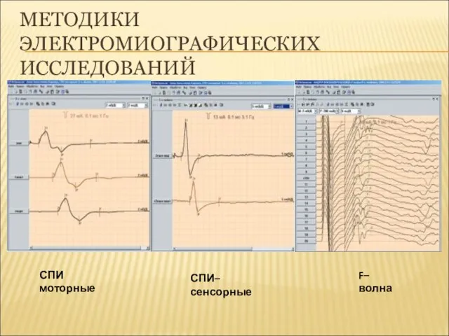 МЕТОДИКИ ЭЛЕКТРОМИОГРАФИЧЕСКИХ ИССЛЕДОВАНИЙ СПИ моторные СПИ–сенсорные F–волна