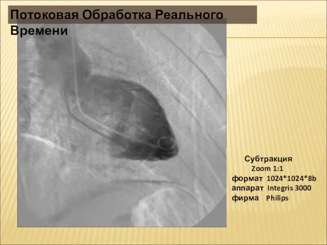 Субтракция Zoom 1:1 формат 1024*1024*8b аппарат Integris 3000 фирма Philips Потоковая Обработка Реального Времени