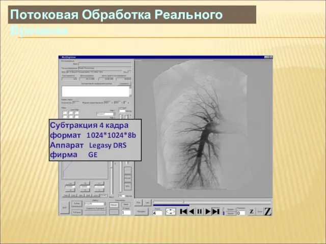 Субтракция 4 кадра формат 1024*1024*8b Аппарат Legasy DRS фирма GE Потоковая Обработка Реального Времени