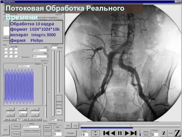 Обработка 10 кадра формат 1024*1024*10b аппарат Integris 3000 фирма Philips Потоковая Обработка Реального Времени