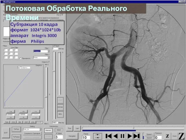 Субтракция 10 кадра формат 1024*1024*10b аппарат Integris 3000 фирма Philips Потоковая Обработка Реального Времени