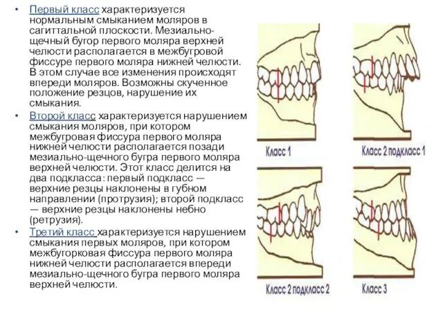 Первый класс характеризуется нормальным смыканием моляров в сагиттальной плоскости. Мезиально-щечный бугор