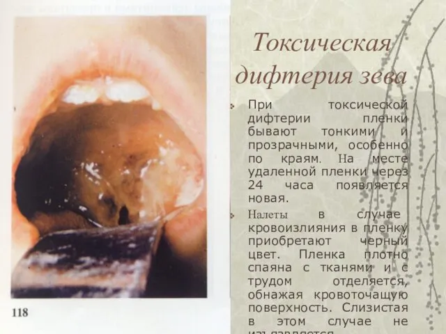 Токсическая дифтерия зева При токсической дифтерии пленки бывают тонкими и прозрачными,