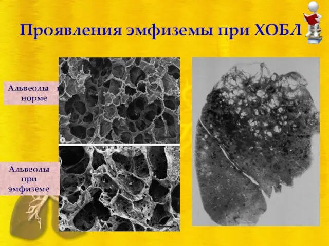 Проявления эмфиземы при ХОБЛ Альвеолы в норме Альвеолы при эмфиземе