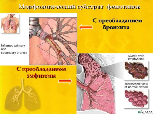 С преобладанием бронхита С преобладанием эмфиземы Морфологический субстрат фенотипов