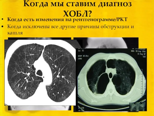 Когда мы ставим диагноз ХОБЛ? Когда есть изменения на рентгенограмме/РКТ Когда