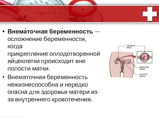 Внема́точная бере́менность — осложнение беременности, когда прикрепление оплодотворенной яйцеклетки происходит вне