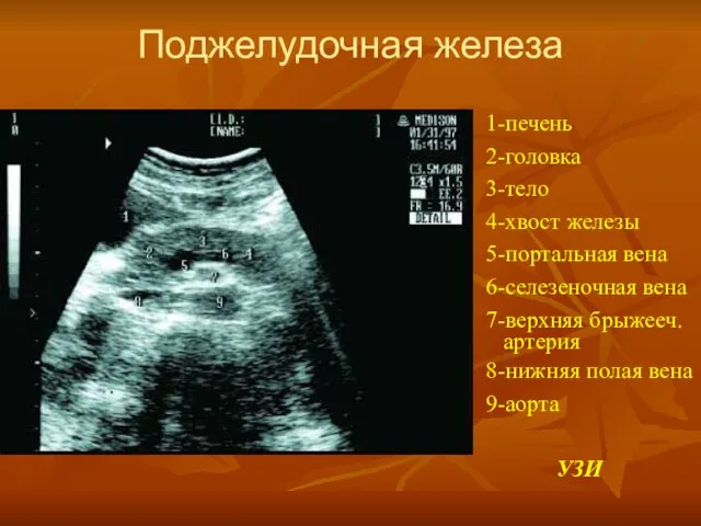 Поджелудочная железа 1-печень 2-головка 3-тело 4-хвост железы 5-портальная вена 6-селезеночная вена