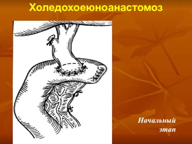 Холедохоеюноанастомоз Начальный этап