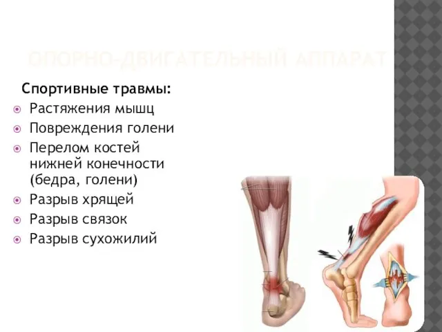 ОПОРНО-ДВИГАТЕЛЬНЫЙ АППАРАТ Спортивные травмы: Растяжения мышц Повреждения голени Перелом костей нижней