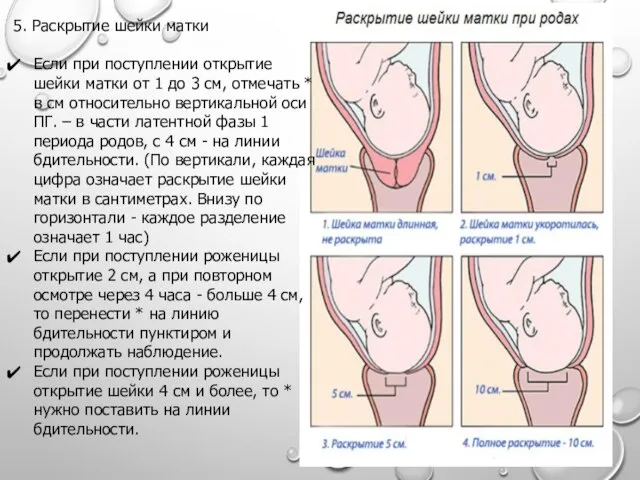 5. Раскрытие шейки матки Если при поступлении открытие шейки матки от