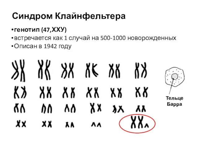 Синдром Клайнфельтера генотип (47,ХХУ) встречается как 1 случай на 500-1000 новорожденных