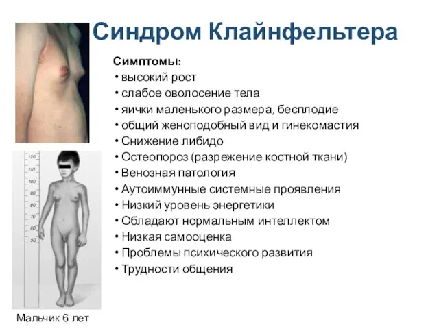 Синдром Клайнфельтера Симптомы: высокий рост слабое оволосение тела яички маленького размера,