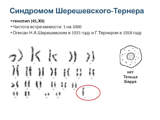 Синдромом Шерешевского-Тернера генотип (45,Х0) Частота встречаемости: 1 на 3000 Описан Н.А.Шерешевским