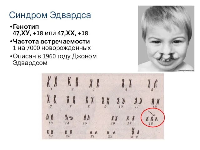 Синдром Эдвардса Генотип 47,ХУ, +18 или 47,ХХ, +18 Частота встречаемости 1