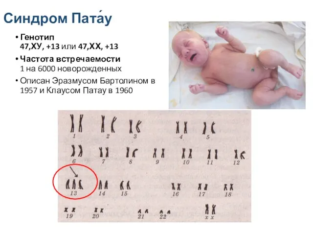 Синдром Пата́у Генотип 47,ХУ, +13 или 47,ХХ, +13 Частота встречаемости 1