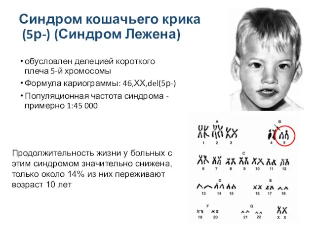 Синдром кошачьего крика (5р-) (Синдром Лежена) обусловлен делецией короткого плеча 5-й