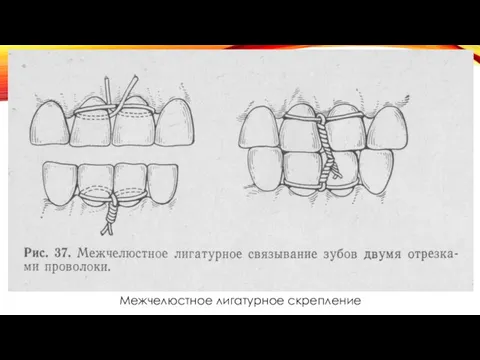 Межчелюстное лигатурное скрепление