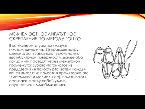 МЕЖЧЕЛЮСТНОЕ ЛИГАТУРНОЕ СКРЕПЛЕНИЕ ПО МЕТОДУ ГОЦКО В качестве лигатуры используют полиамидную