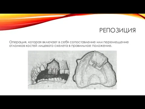 РЕПОЗИЦИЯ Операция, которая включает в себя сопоставление или перемещение отломков костей лицевого скелета в правильное положение.