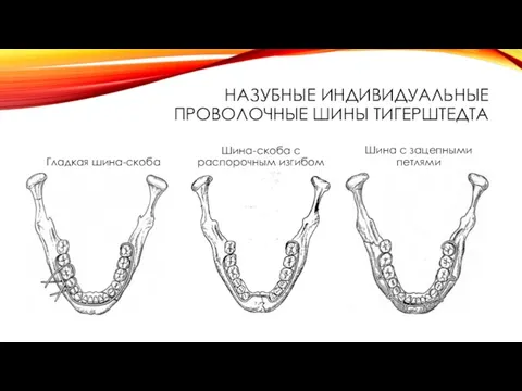 НАЗУБНЫЕ ИНДИВИДУАЛЬНЫЕ ПРОВОЛОЧНЫЕ ШИНЫ ТИГЕРШТЕДТА Гладкая шина-скоба Шина-скоба с распорочным изгибом Шина с зацепными петлями