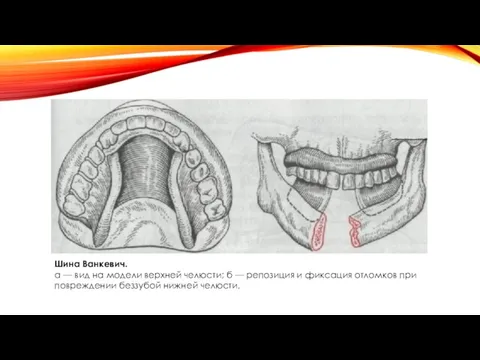 Шина Ванкевич. а — вид на модели верхней челюсти; б —