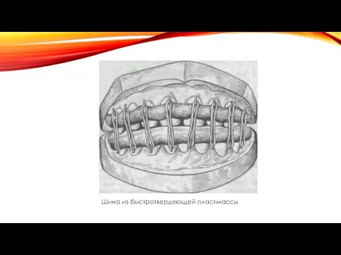 Шина из быстротвердеющей пластмассы