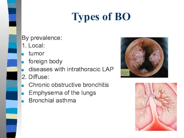 Types of BO By prevalence: 1. Local: tumor foreign body diseases