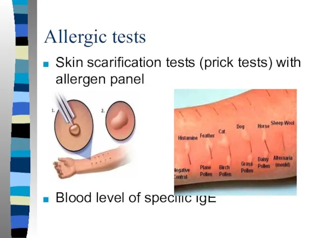 Allergic tests Skin scarification tests (prick tests) with allergen panel Blood level of specific IgE