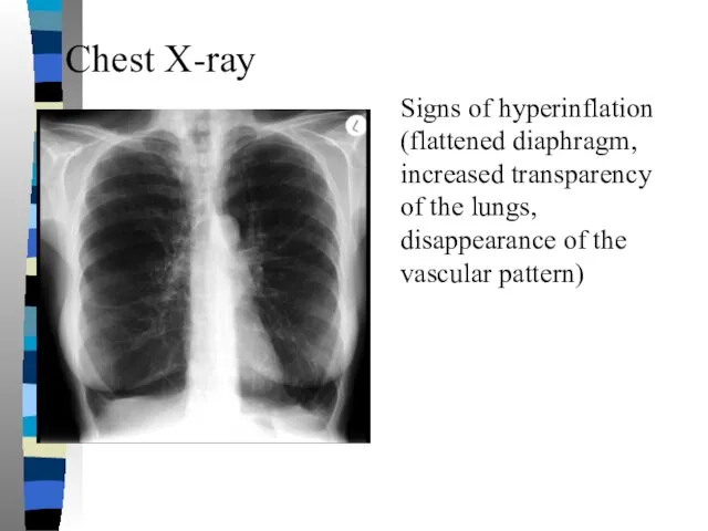 Chest X-ray Signs of hyperinflation (flattened diaphragm, increased transparency of the