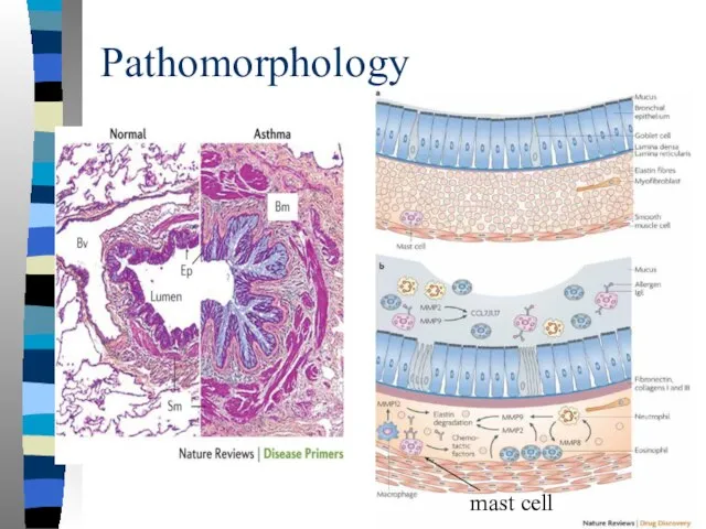 Pathomorphology mast cell