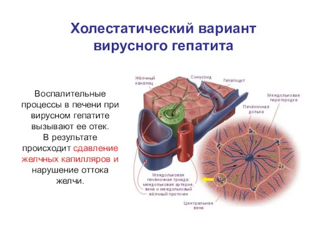 Холестатический вариант вирусного гепатита Воспалительные процессы в печени при вирусном гепатите