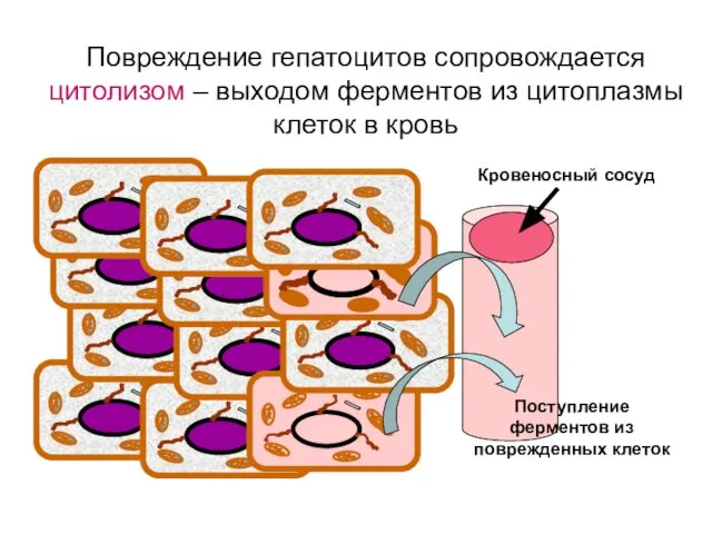 Повреждение гепатоцитов сопровождается цитолизом – выходом ферментов из цитоплазмы клеток в