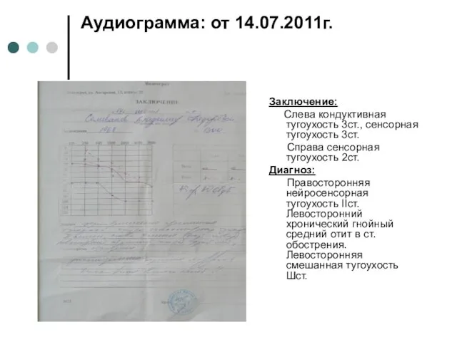 Аудиограмма: от 14.07.2011г. Заключение: Слева кондуктивная тугоухость 3ст., сенсорная тугоухость 3ст.