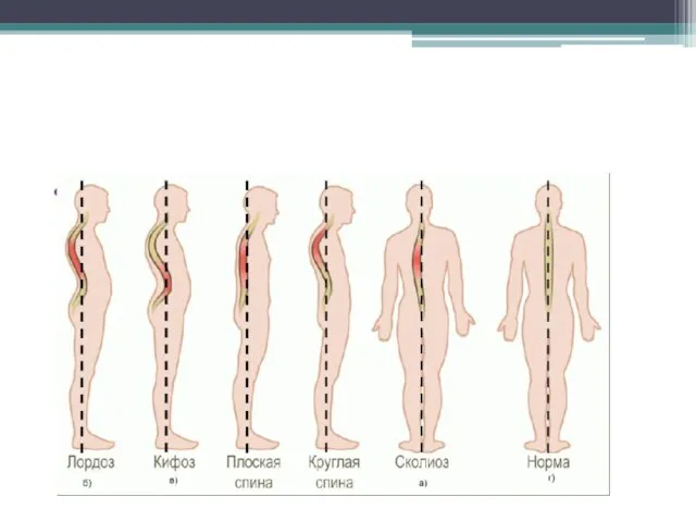Виды нарушения осанки