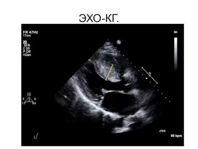ЭХО-КГ. 5,9 см