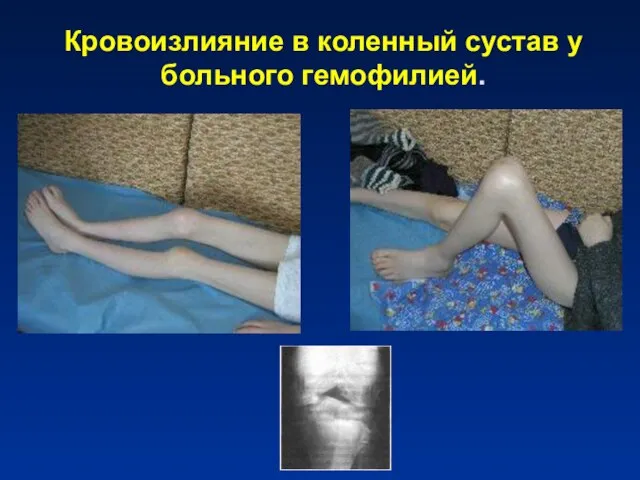 Кровоизлияние в коленный сустав у больного гемофилией.