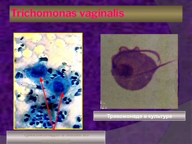 Trichomonas vaginalis Трихомонады в мазке из влагалища Трихомонада в культуре