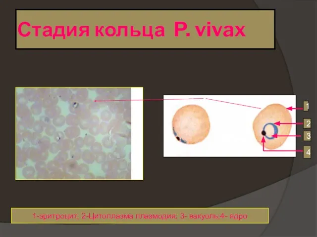 Стадия кольца P. vivax 1 2 3 4 1-эритроцит; 2-Цитоплазма плазмодия; 3- вакуоль;4- ядро