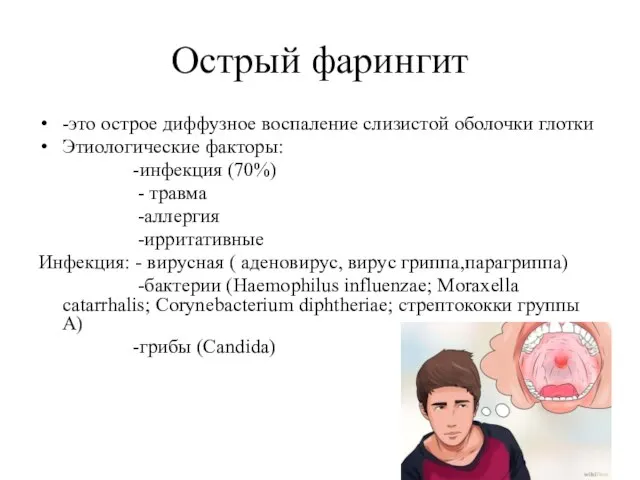 Острый фарингит -это острое диффузное воспаление слизистой оболочки глотки Этиологические факторы: