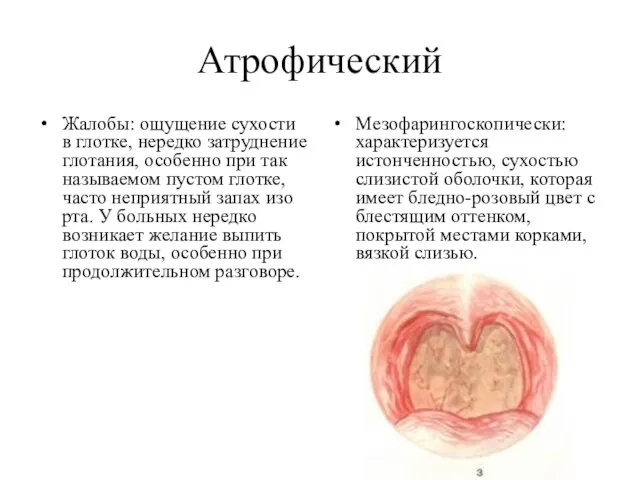 Атрофический Жалобы: ощущение сухости в глотке, нередко затруднение глотания, особенно при