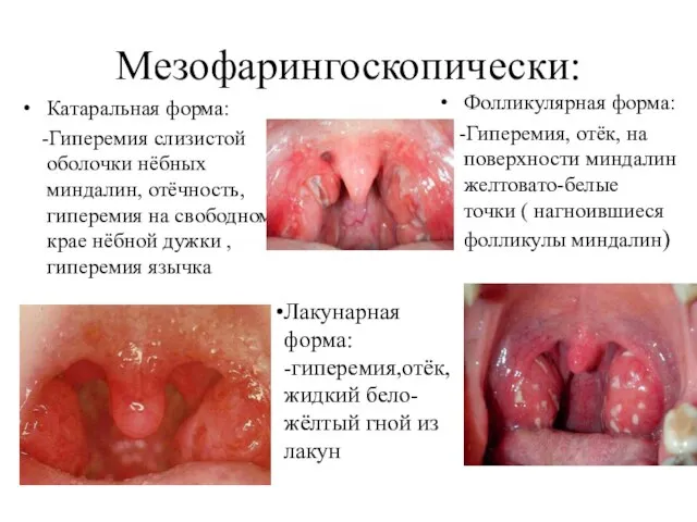 Мезофарингоскопически: Катаральная форма: -Гиперемия слизистой оболочки нёбных миндалин, отёчность,гиперемия на свободном