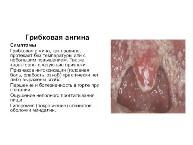 Грибковая ангина Симптомы Грибковая ангина, как правило, протекает без температуры или
