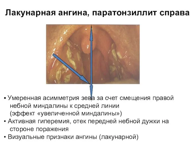 Лакунарная ангина, паратонзиллит справа Умеренная асимметрия зева за счет смещения правой