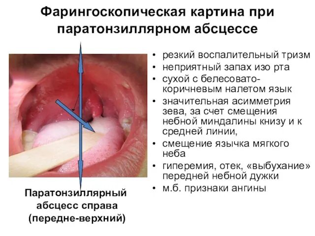 Фарингоскопическая картина при паратонзиллярном абсцессе резкий воспалительный тризм неприятный запах изо