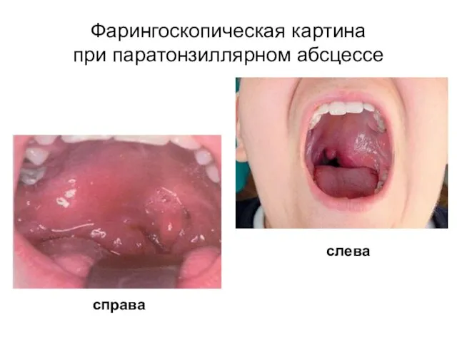 Фарингоскопическая картина при паратонзиллярном абсцессе слева справа