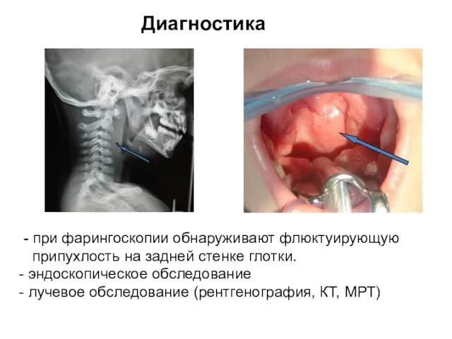 Диагностика - при фарингоскопии обнаруживают флюктуирующую припухлость на задней стенке глотки.